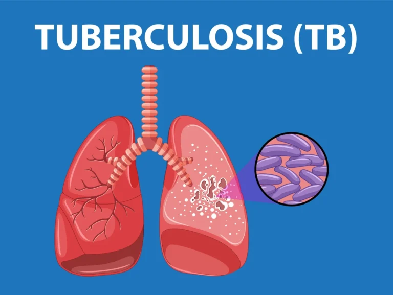 Tuberculosis (TB)