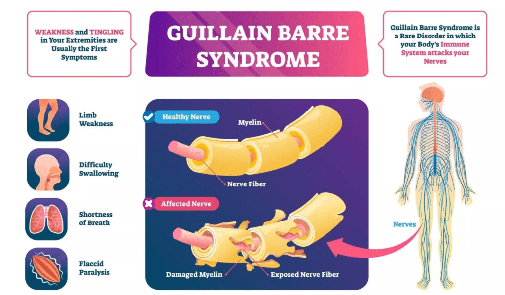 Guillain-Barré Syndrome